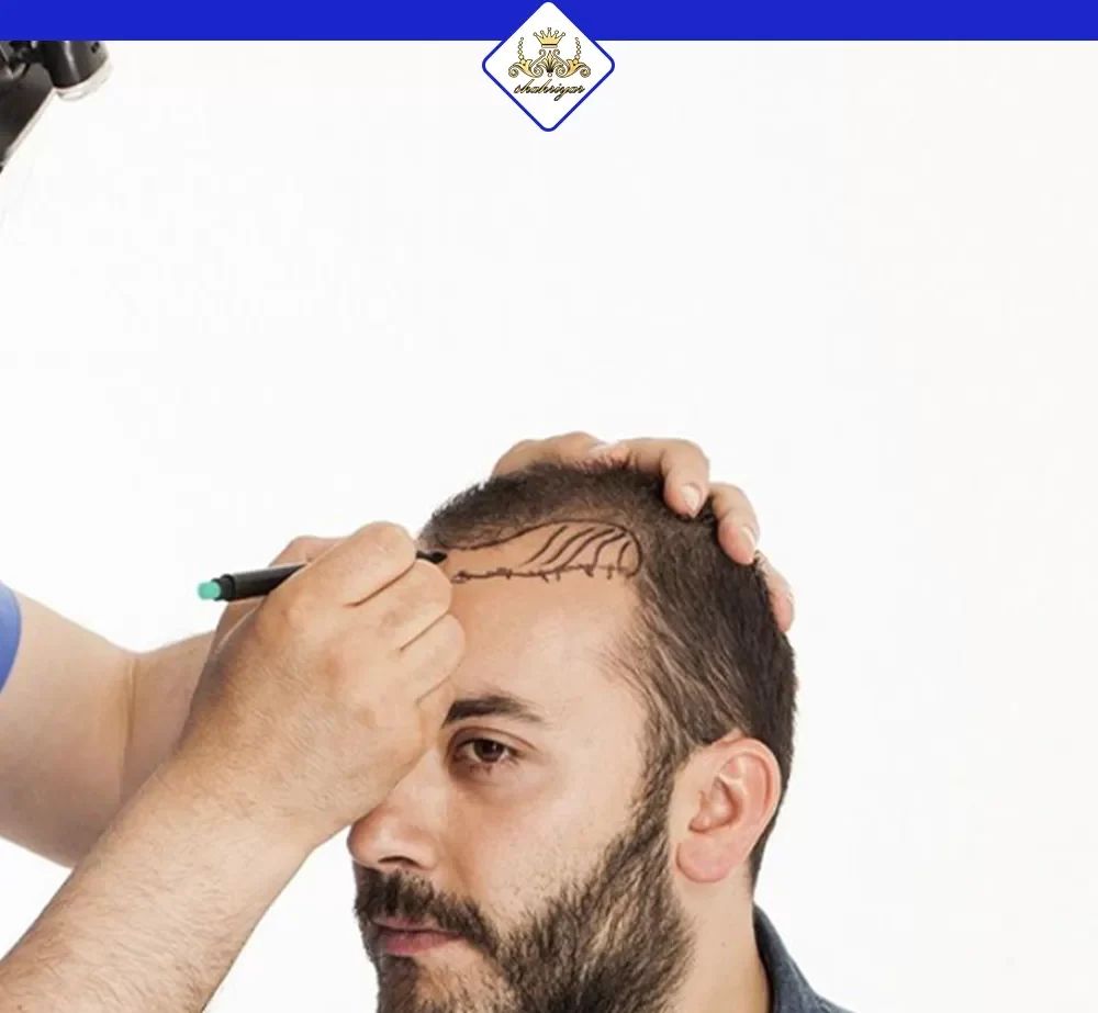 ۶ روش نگهداری بعد از کاشت مو