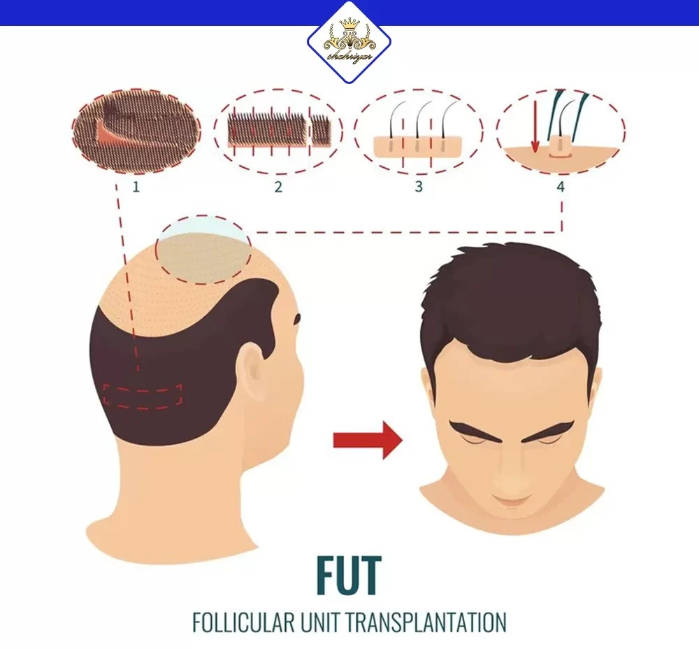 کاشت مو به روش FUT چیست؟ مزایا و معایب آن کدامند
