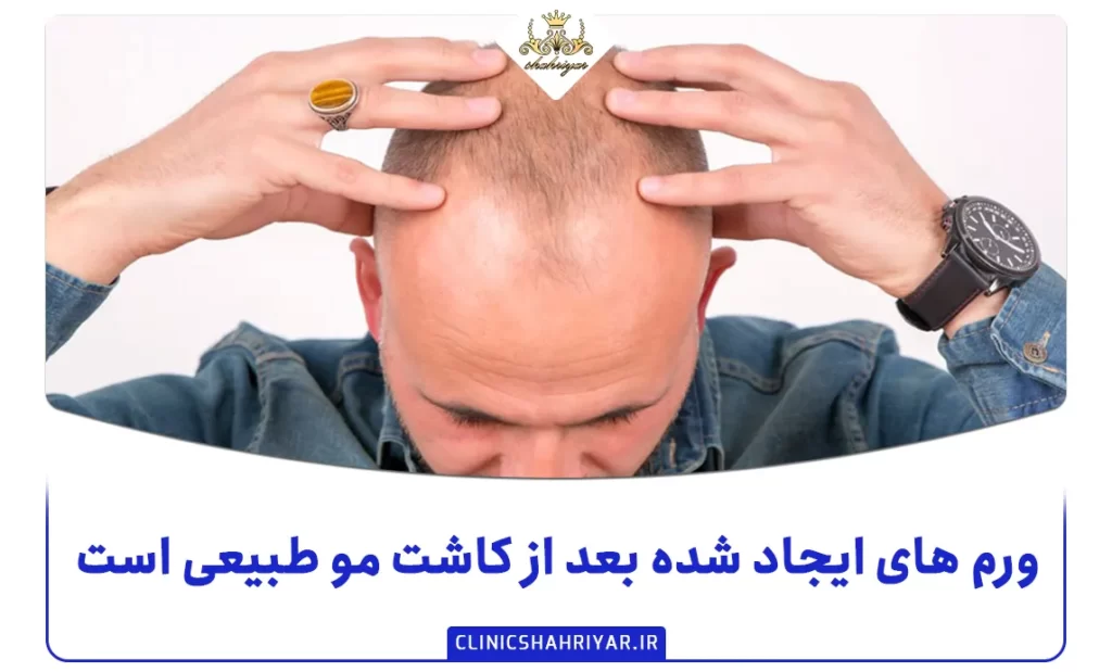ورم های ایجاد شده بعد از کاشت مو طبیعی است؟