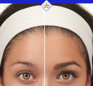 ۶ دلیل ریزش ابرو کدام است؟ راه های درمان آن