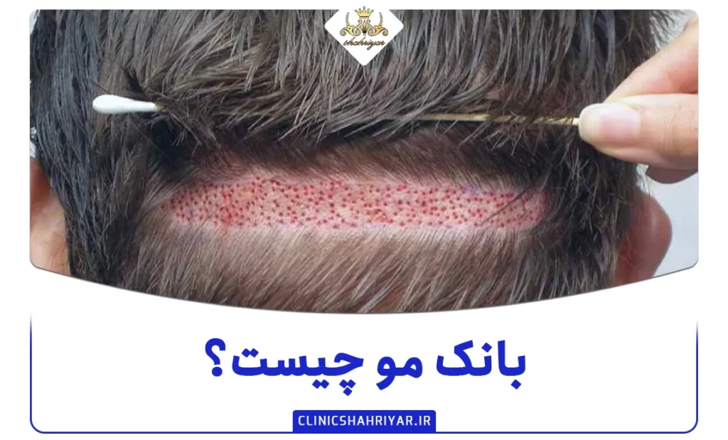 بانک مو چیست؟ چه مزایایی در کاشت مو داردبانک مو چیست؟ چه مزایایی در کاشت مو دارد