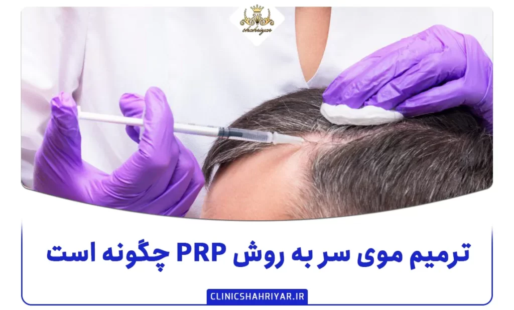 ترمیم موی سر به روش PRP چگونه است؟