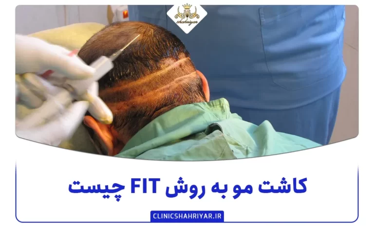 کاشت مو به روش FIT چیست؟