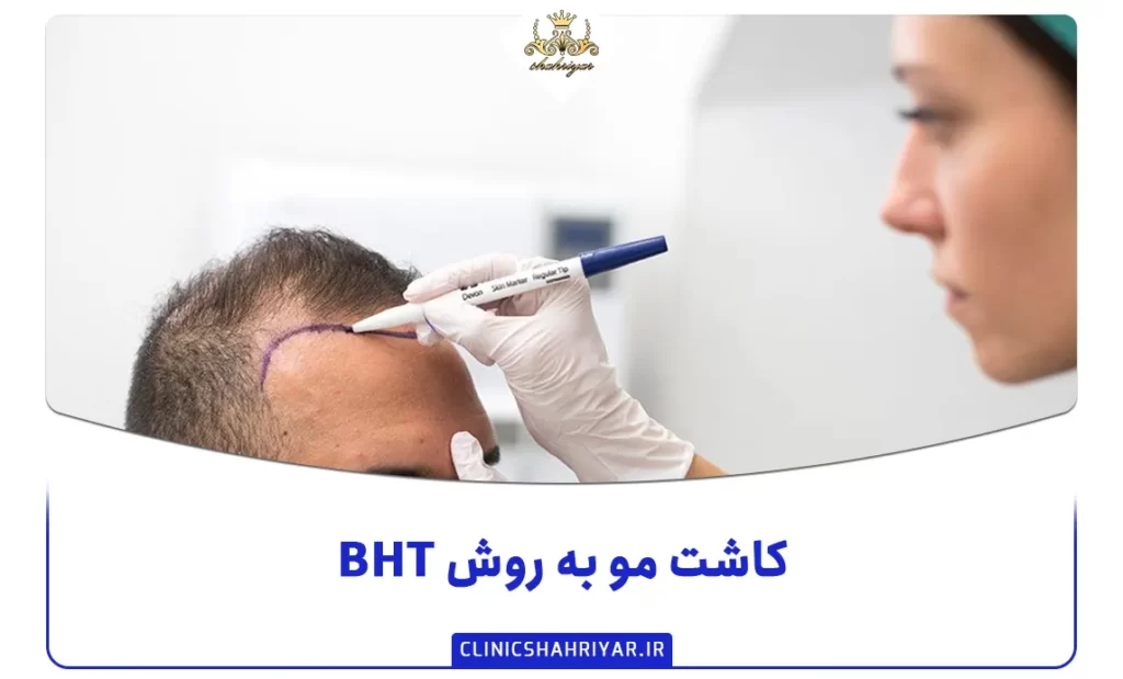 کاشت مو به روش BHT چگونه است و برای چه کسانی مناسب است؟_کلینیک شهریار