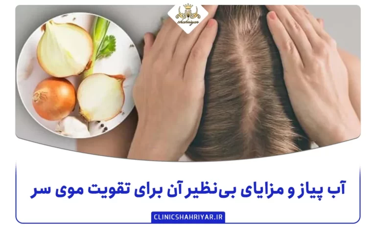 آب پیاز و مزایای بی‌نظیر آن برای تقویت موی سر_کلینیک شهریار