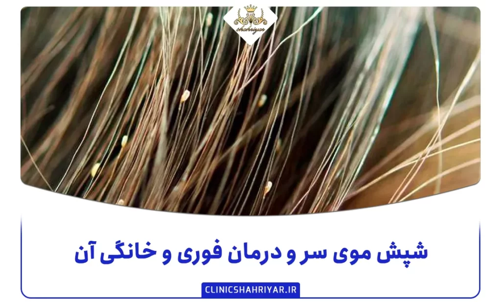 شپش موی سر و درمان فوری و خانگی آن_کلینیک شهریار