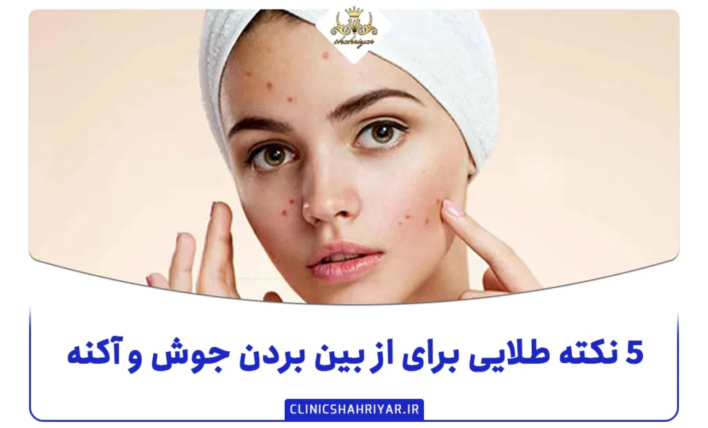 ۵ نکته طلایی برای از بین بردن جوش و آکنه-کلینیک شهریار