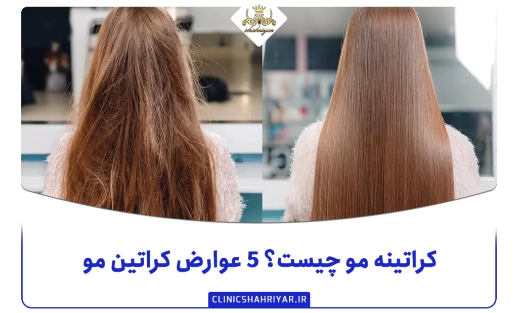 کراتینه مو چیست؟ ۵ عوارض کراتین مو_کلینیک شهریار