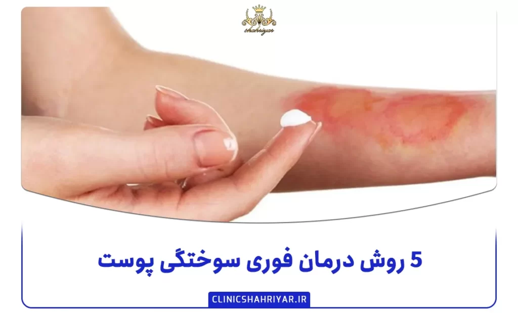 ۵ روش درمان فوری سوختگی پوست_کلینیک شهریار