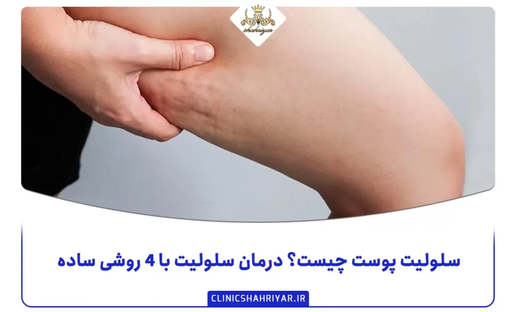 سلولیت پوست چیست؟ درمان سلولیت با ۴ روشی ساده_کلینیک شهریار