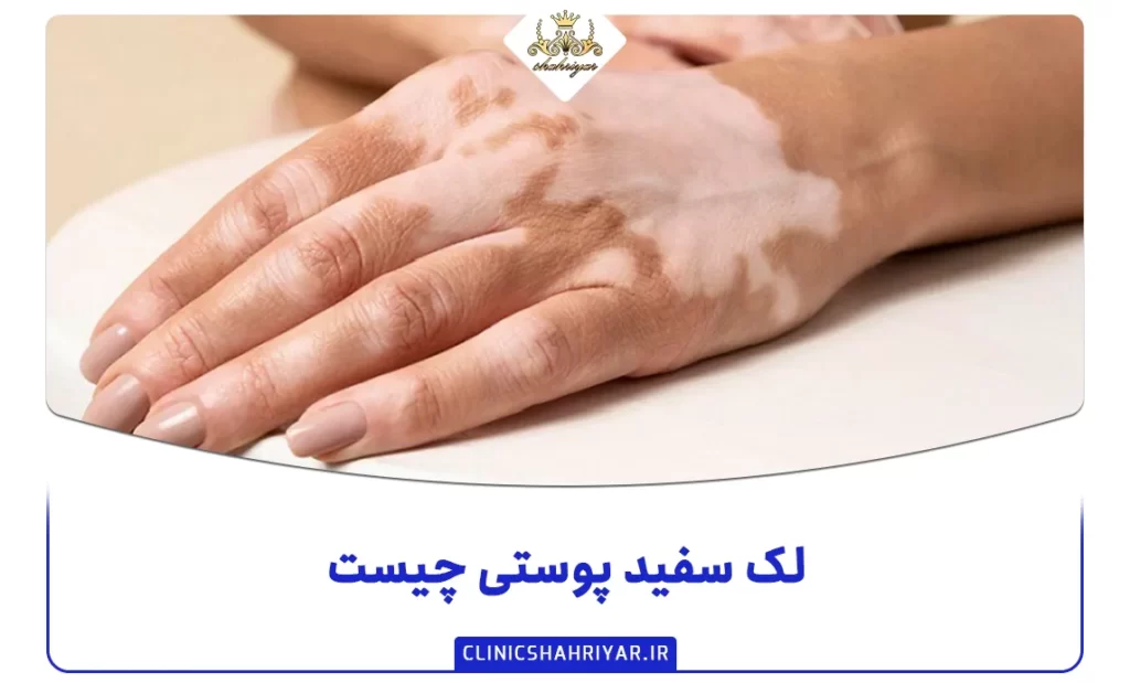 لک سفید پوستی چیست؟ دلیل ایجاد آن_کلینیک شهریار
