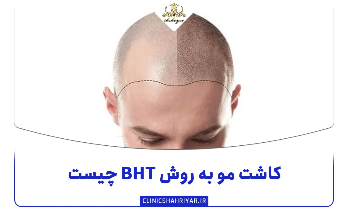 کاشت مو به روش BHT چیست؟ بررسی کامل آن_کلینیک شهریار