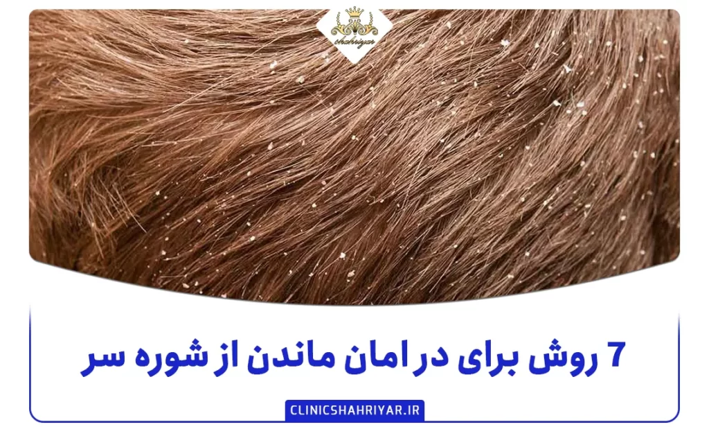 ۷ روش برای در امان ماندن از شوره سر_کلینیک شهریار