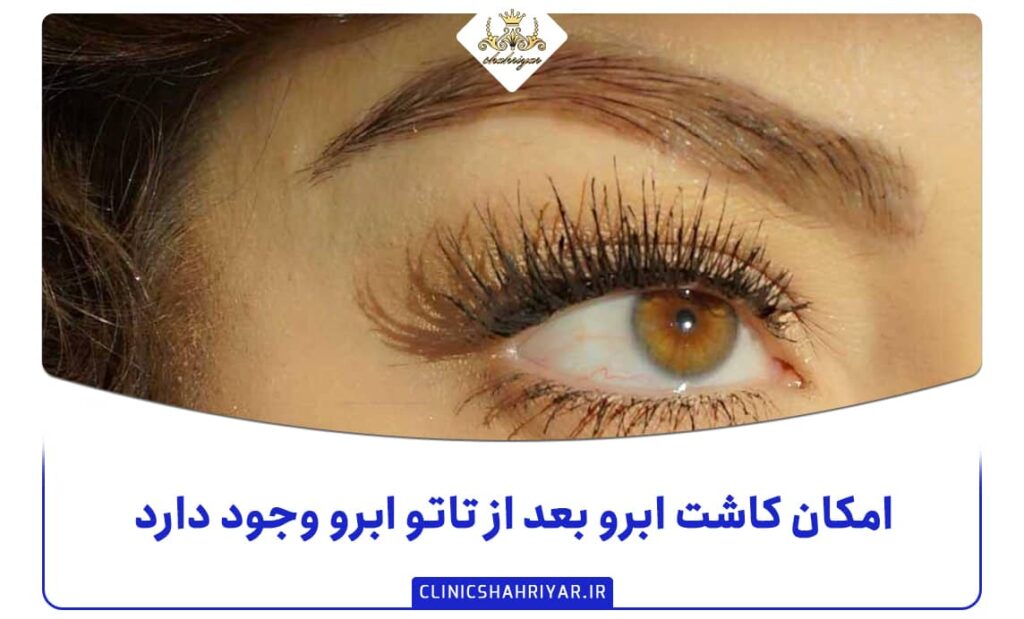 امکان کاشت ابرو بعد از تاتو ابرو وجود دارد؟_کلینیک شهریار