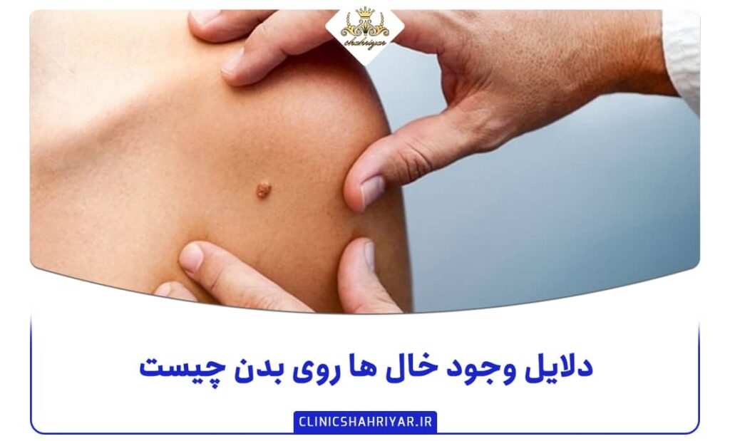 دلایل وجود خال ها روی بدن چیست؟_کلینیک شهریار