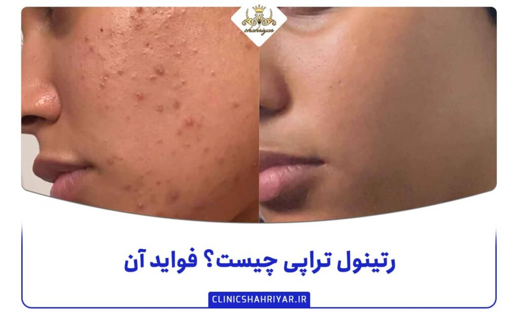 رتینول تراپی چیست؟ تاثیر آن روی پوست صورت_کلینیک شهریار