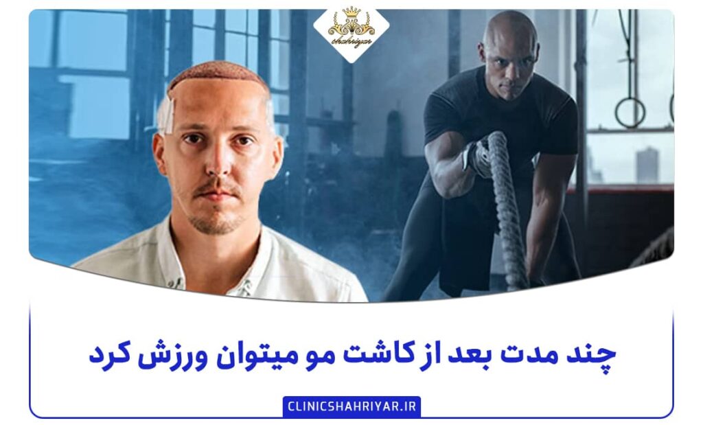 چند مدت بعد از کاشت مو میتوان ورزش کرد ؟_کلینیک شهریار