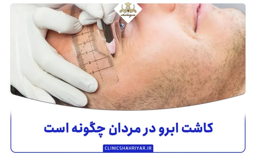 کاشت ابرو در مردان چگونه است؟ هرآنچه که باید بدانید_کلینیک شهریار