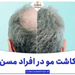 کاشت مو در افراد مسن ؛ توصیه های مهم_کلینیک شهریار